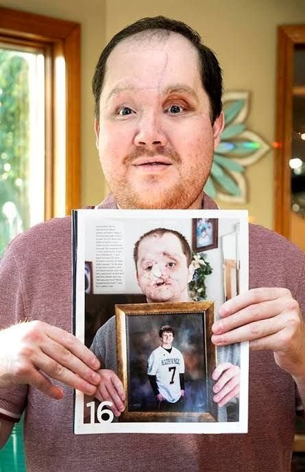 Family sees God's hand in son's survival after suicide attempt, successful  face transplant - Catholic Review